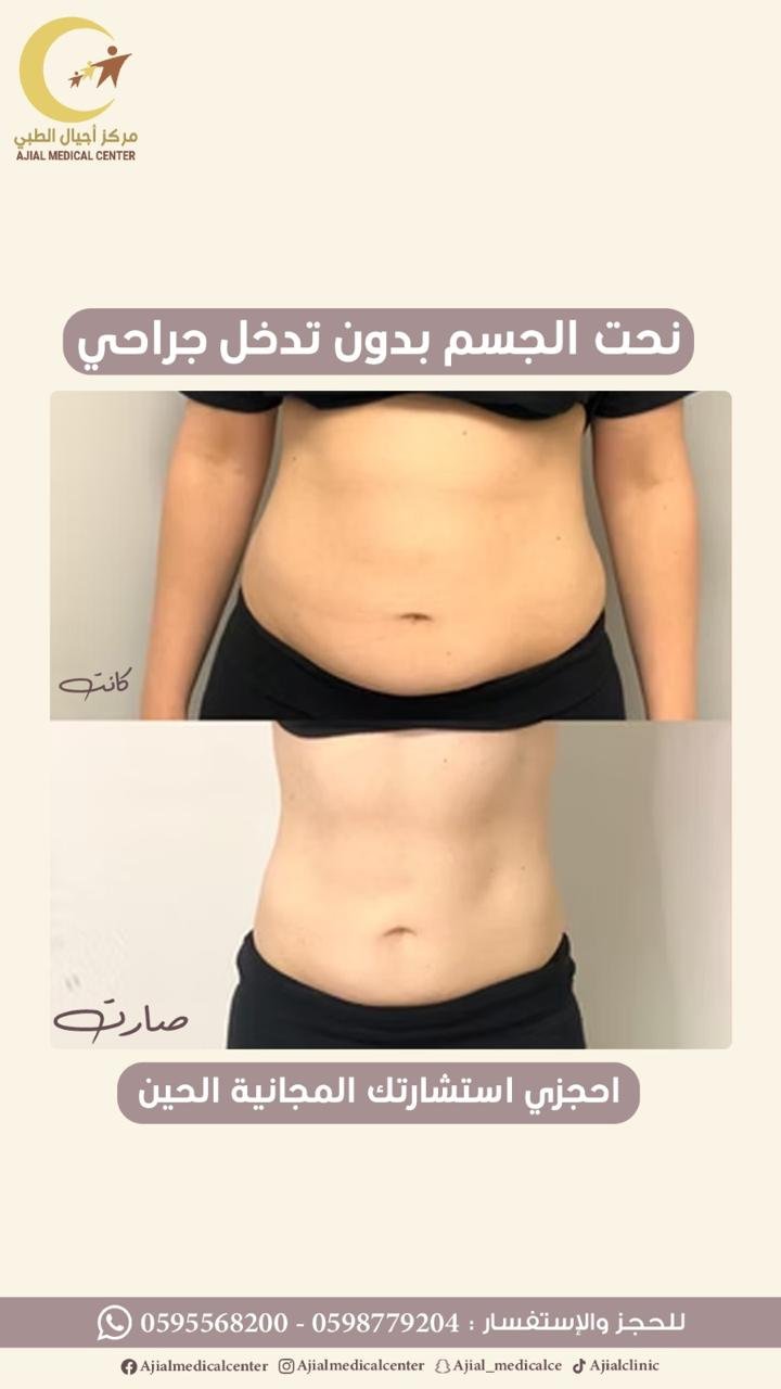 نحت الجسم بدون جراحة