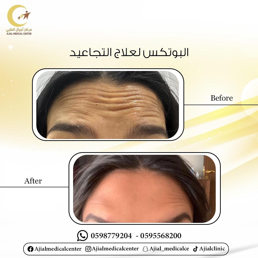 بوتوكس لعلاج التجاعيد