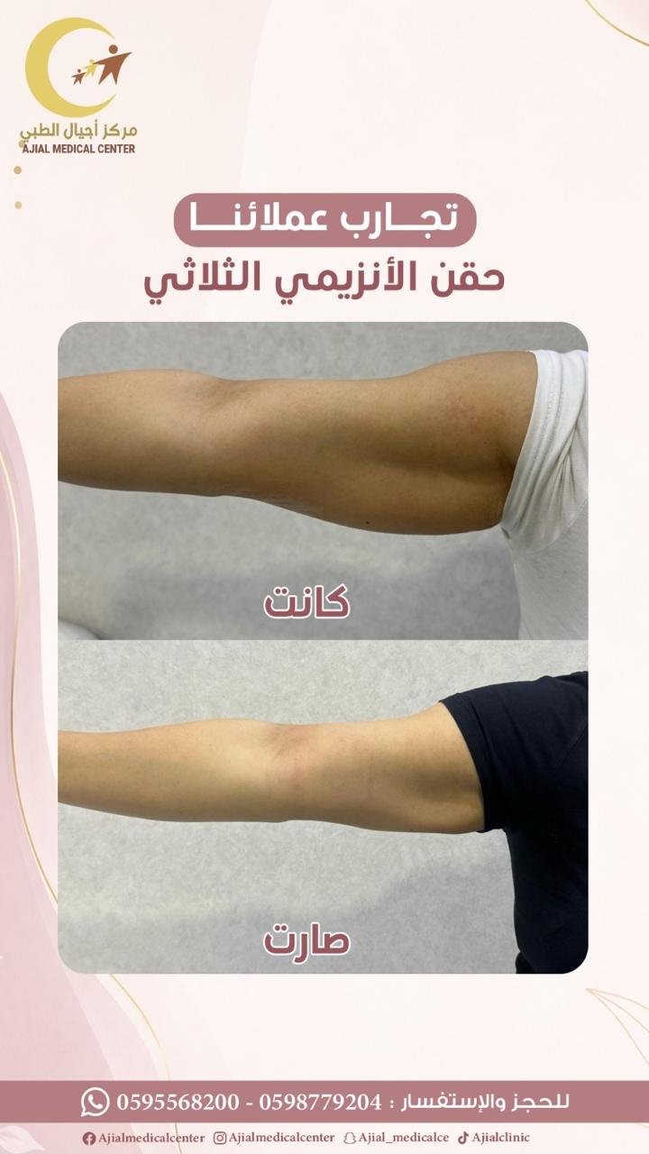حقن الأنزيمي الثلاثي