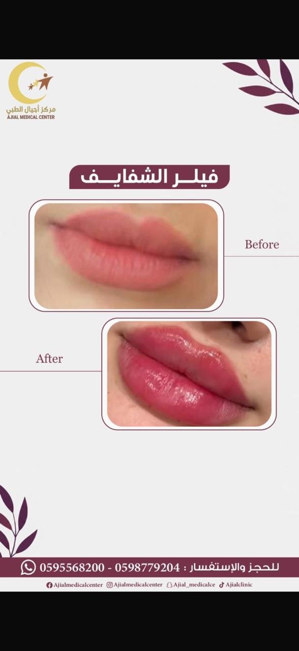 فيلر الشفايف
