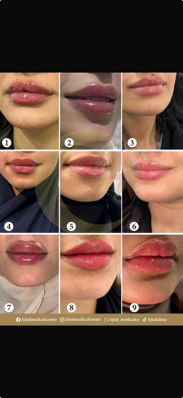 نماذج متعددة لفيلر الشفايف