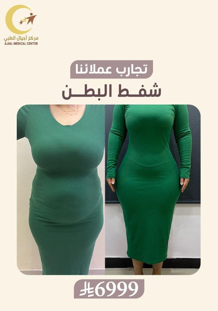 شفط البطن