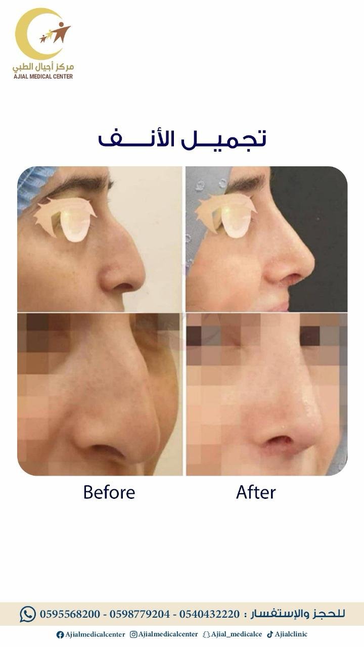 تجميل الأنف بالفيلر