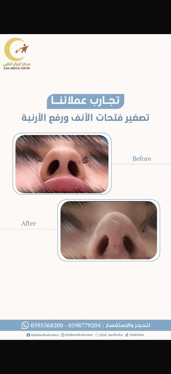 تصغير فتحات الأنف ورفع الأرنبة